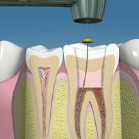 Endodoncia Mecanizada: Precisión, Eficiencia y Revolución en la Terapia de Conductos con Motor Endodóntico