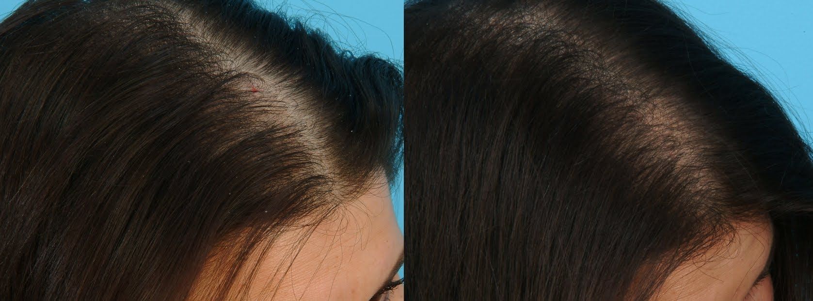 Dile adiós a la caída del cabello Clinicasesteticas.cl