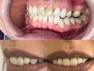 Implantes dentales - 619585