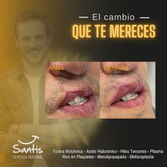 Aumento de labios - Clínica Santis