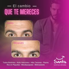 Rejuvenecimiento facial - Clínica Santis