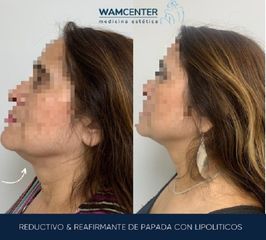 Liposucción de papada - WamCenter