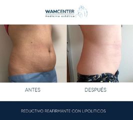 Liposucción sin cirugía - WamCenter