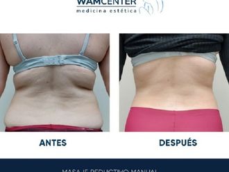 Masaje reductivo antes y después - 847050