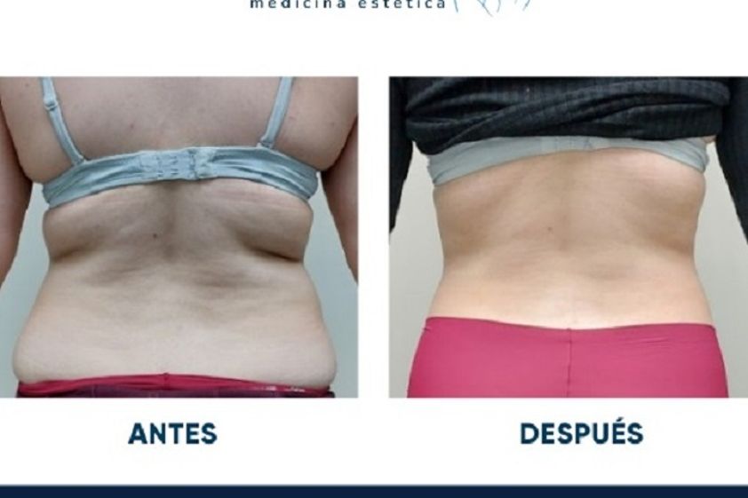 Masaje reductivo antes y después - 847050
