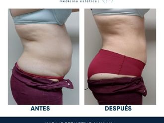 Masaje reductivo antes y después - 847051
