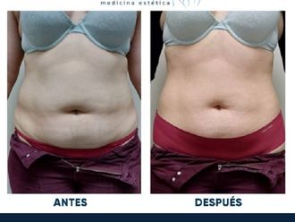 Masaje reductivo antes y después - 847052