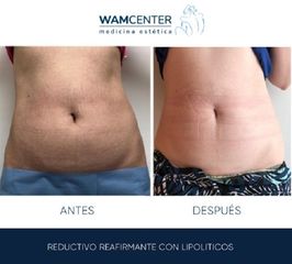 Liposucción sin cirugía - WamCenter