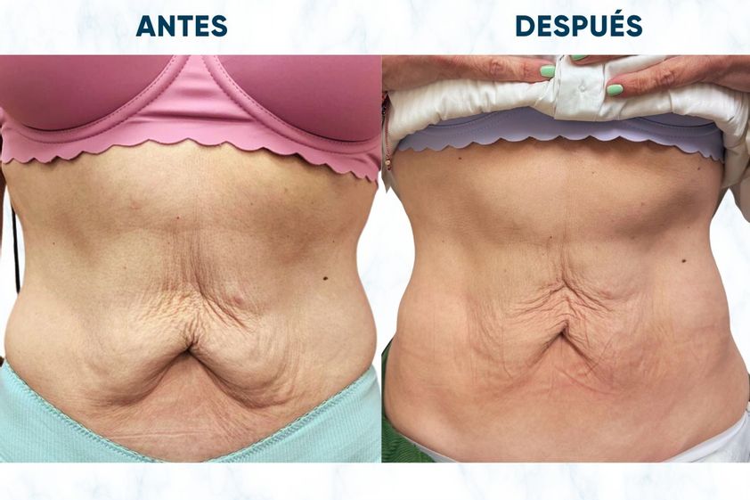 Radiofrecuencia antes y después - 852829