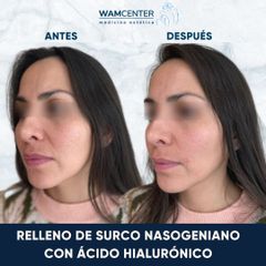 Ácido hialurónico - WamCenter