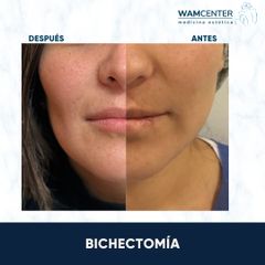 Bichectomía - WamCenter