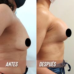 Mastopexia - Dra. Yelitza Castellanos