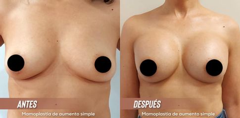 Aumento mamario - Dra. Yelitza Castellanos