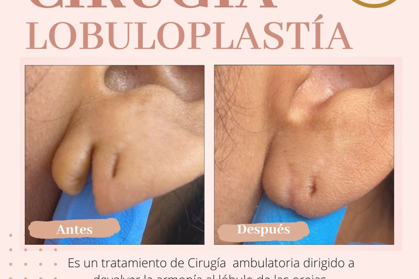 Otoplastia antes y después - 863525