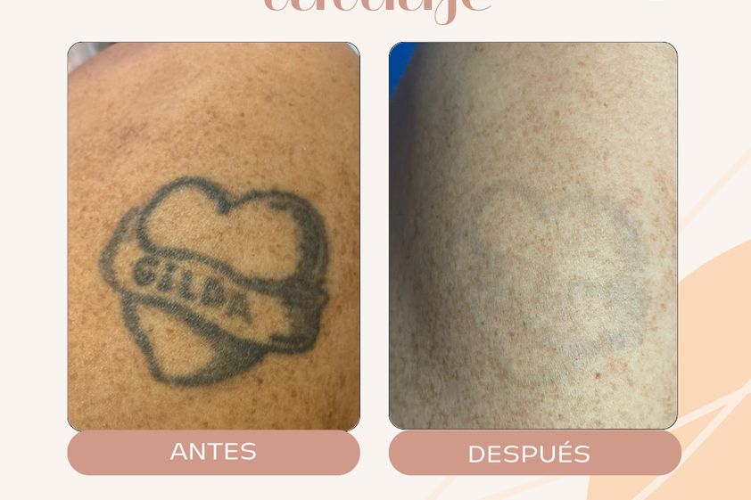 Borrar tatuajes antes y después - 863529