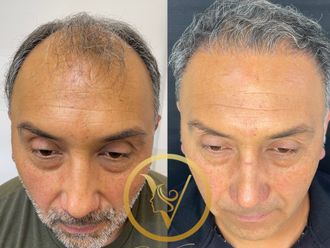 Alopecia antes y después - 871828