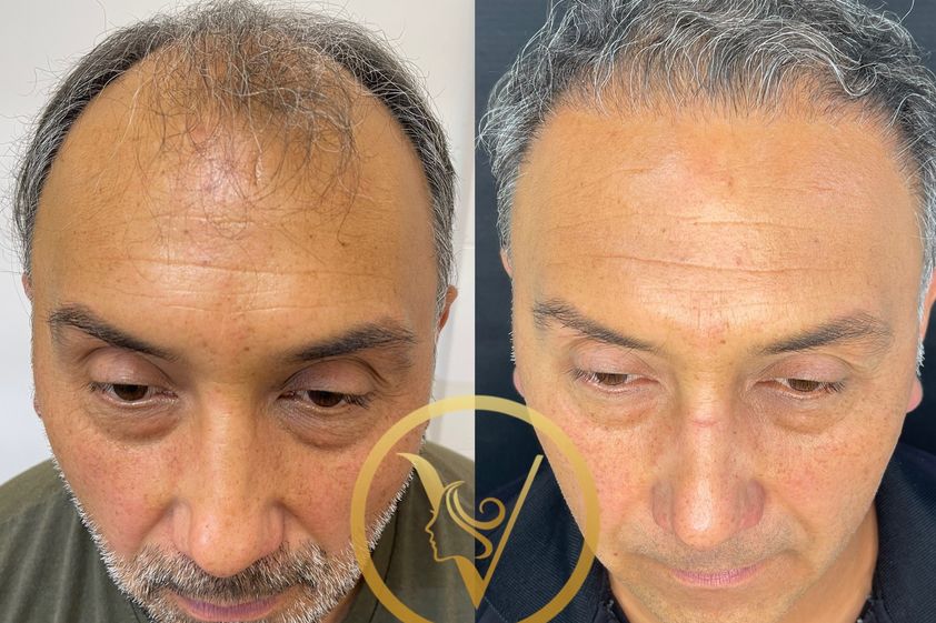 Alopecia antes y después - 871828