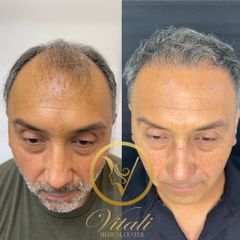 Alopecia - Vitali Medical Center