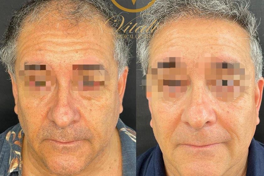 Implante Capilar antes y después - 871930