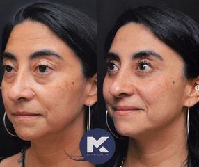 Blefaroplastia - Dr. Matías Kufeke