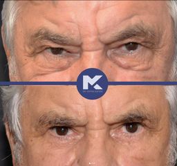 Blefaroplastia  - Dr. Kufeke