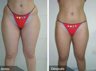 Liposuccion