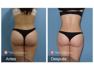 Liposucción