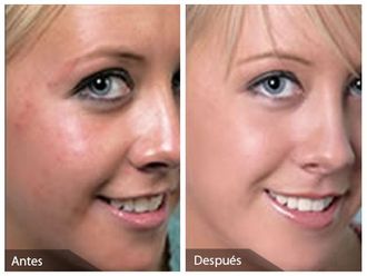 Peeling - 647149