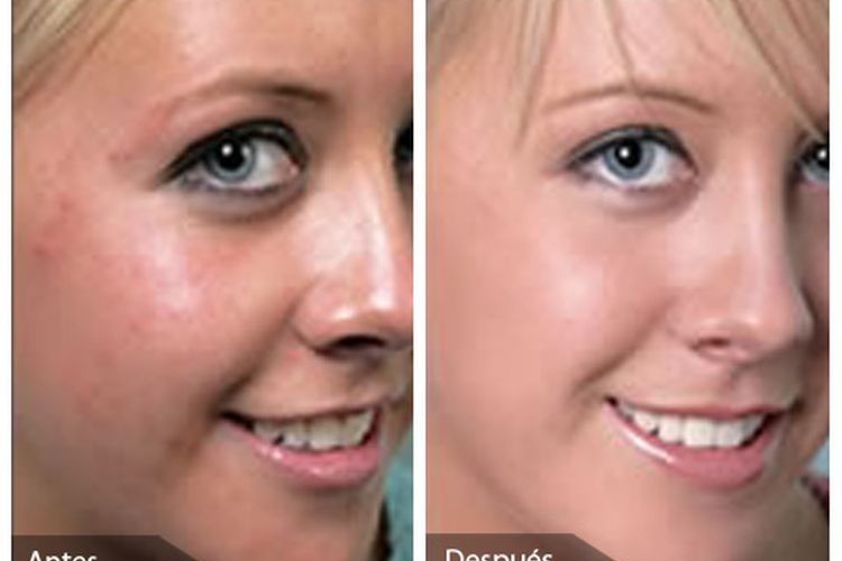 Peeling antes y después - 647149