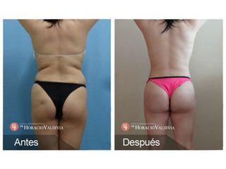 Liposucción