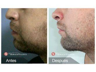 Mentoplastia - 647154