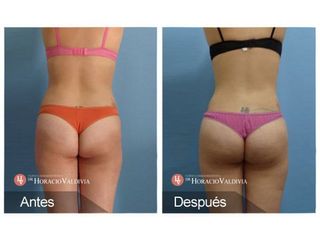 Liposucción