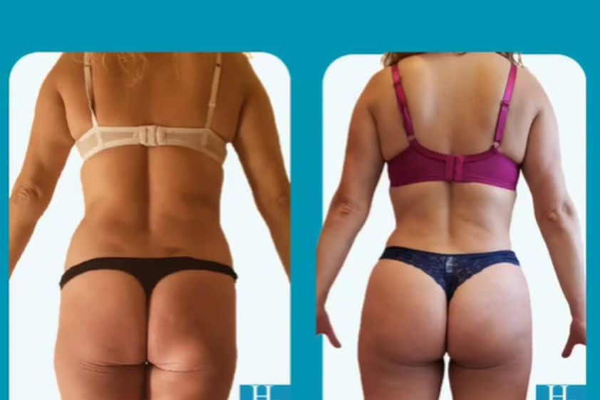 Lipoescultura antes y después - 863425