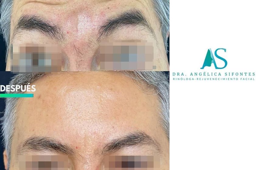 Bótox antes y después - 739423