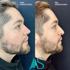Rinoplastia - Dra. Angelica Sifontes Muñoz