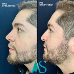 Rinoplastia - Dra. Angelica Sifontes Muñoz