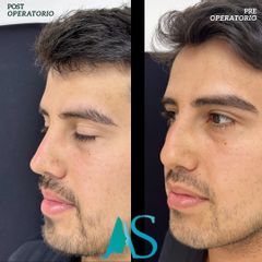 Rinoplastia - Dra. Angelica Sifontes Muñoz