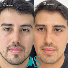 Rinoplastia - Dra. Angelica Sifontes Muñoz