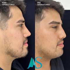 Rinoplastia - Dra. Angelica Sifontes Muñoz