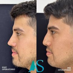 Rinoplastia - Dra. Angelica Sifontes Muñoz