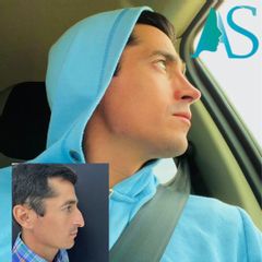 Rinoplastia - Dra. Angelica Sifontes Muñoz
