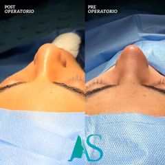 Rinoplastia - Dra. Angelica Sifontes Muñoz