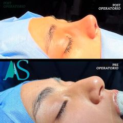 Rinoplastia - Dra. Angelica Sifontes Muñoz