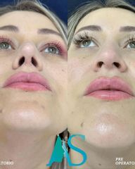 Rinoplastia - Dra. Angelica Sifontes Muñoz