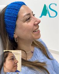 Rinoplastia - Dra. Angelica Sifontes Muñoz
