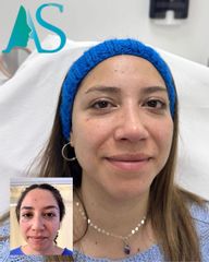 Rinoplastia - Dra. Angelica Sifontes Muñoz