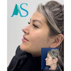 Rinoplastia - Dra. Angelica Sifontes Muñoz