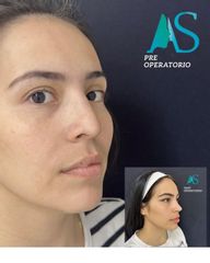 Rinoplastia - Dra. Angelica Sifontes Muñoz