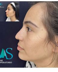 Rinoplastia - Dra. Angelica Sifontes Muñoz