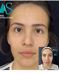 Rinoplastia - Dra. Angelica Sifontes Muñoz